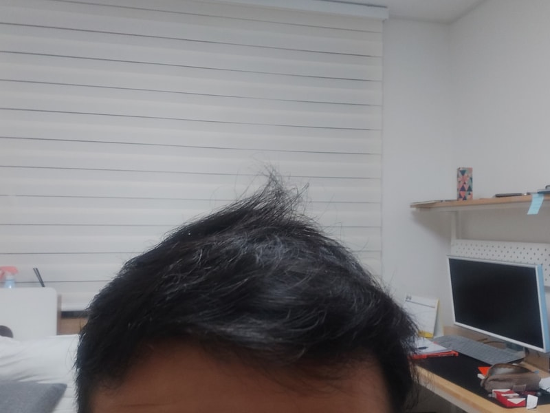 [Modi Hair Implant Clinic 4,000-mo hair - 6 months after the nasogastric procedure]