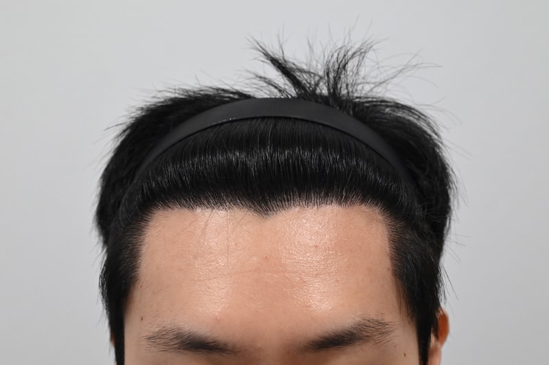M字額のヘアライン矯正、非切開ヒドゥンカットの1年目の最終レビューです