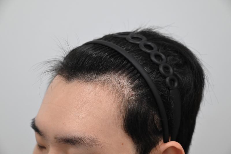 M字額のヘアライン矯正、非切開ヒドゥンカットの第2週目のレビューです