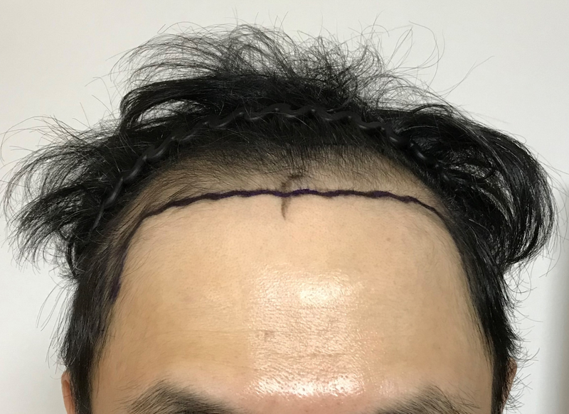 자라다 의원 9개월 변화 과정 3000모낭