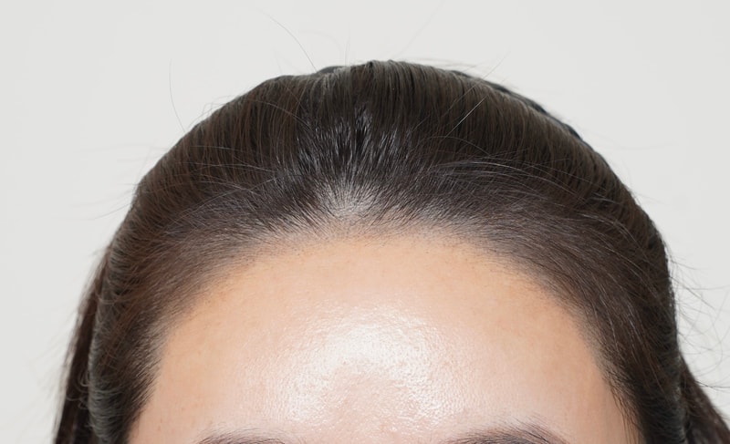 2주 경과 너무 만족스러워요