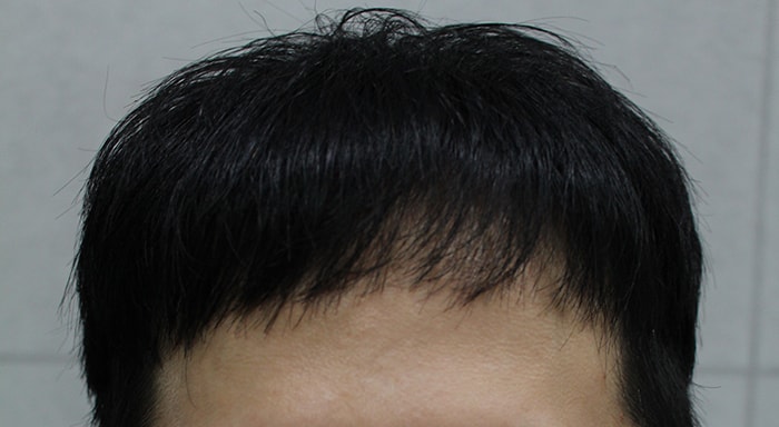 ヘアライン2800毛の手術して6ヶ月間病院に行ってきました