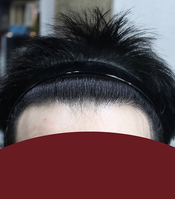 It's been a year and four months since my hairline was 2,300
