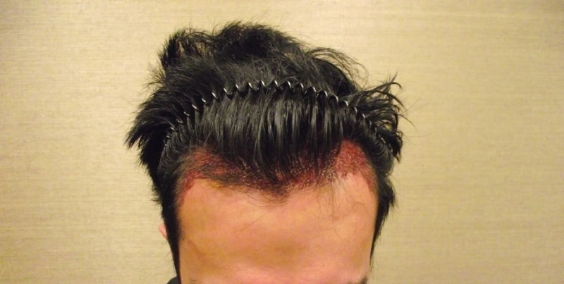 수술후.jpg