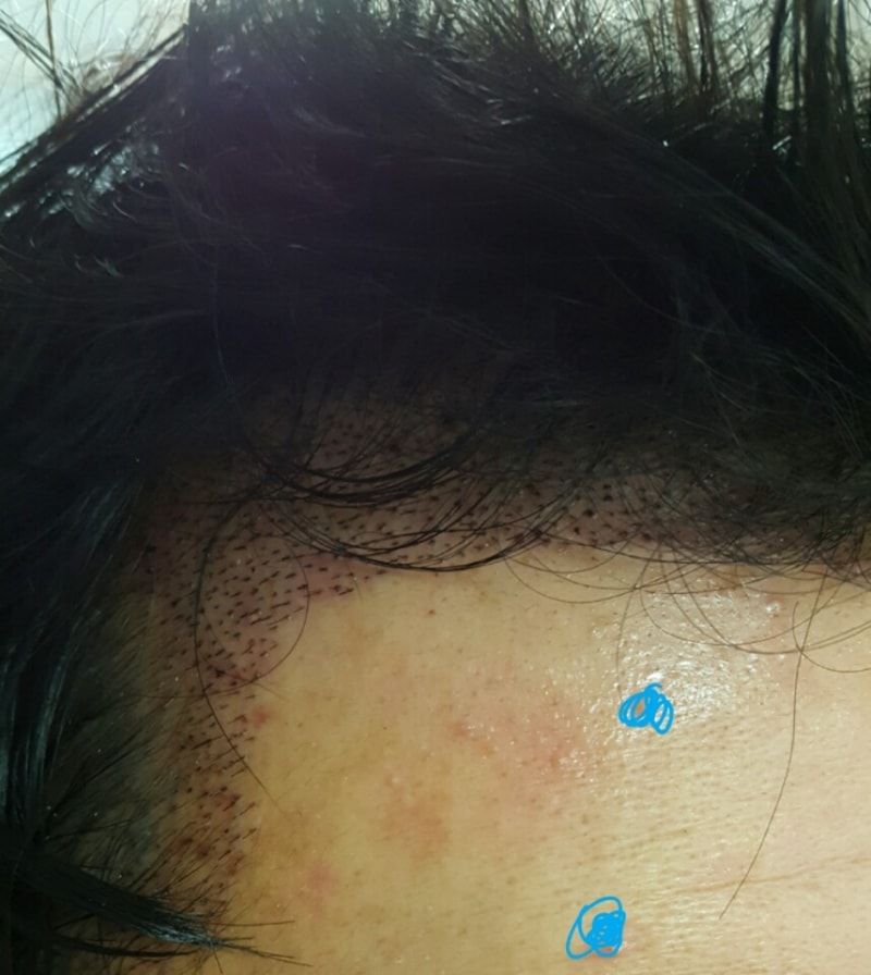 Day 4 of hair transplantation