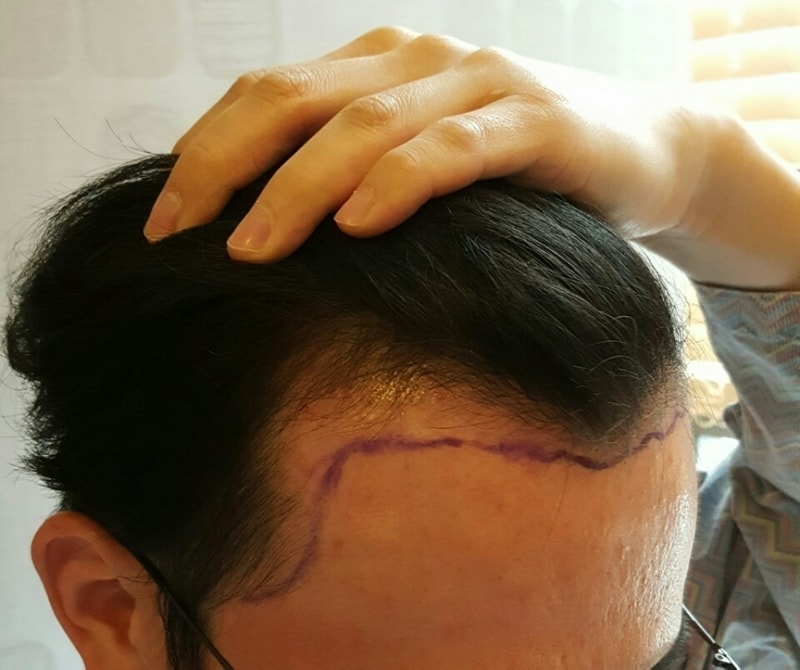 I got an M-shaped 2500-mo incision today!