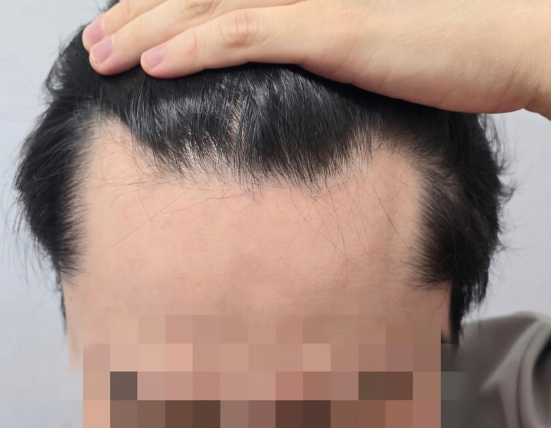 モ·ジェリム、パク·セホ院長の手術レビューを投稿します！