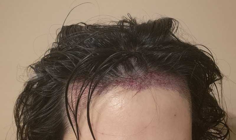 압구정 모우림의원 모발이식 후기