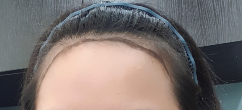 发际线是6个月后期~