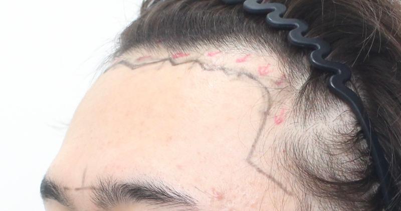 [経過チェック] ★モプロ医院★ ヘアライン 毛髪移植 切開 3600毛 11日経過