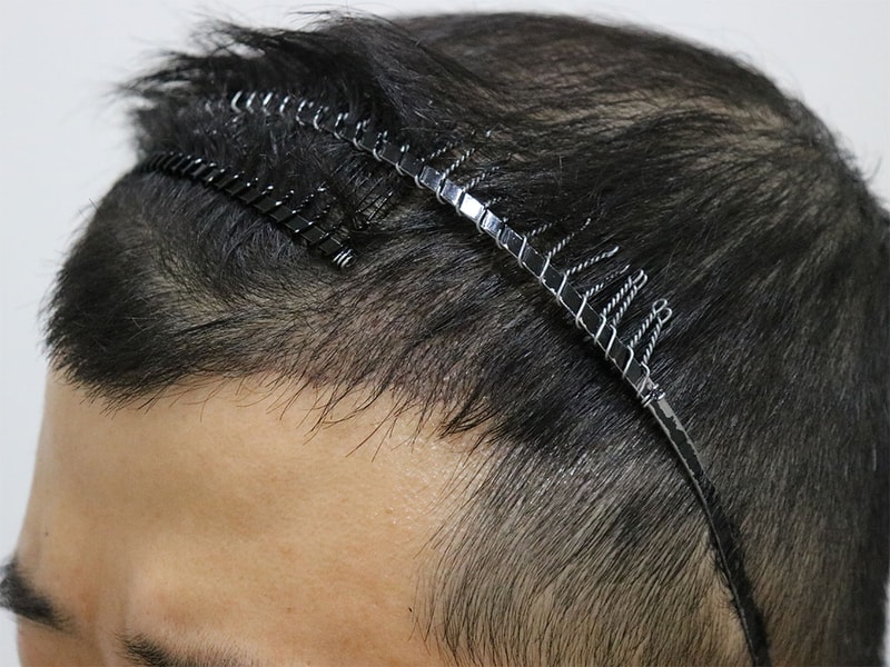 수술 후 3.jpg
