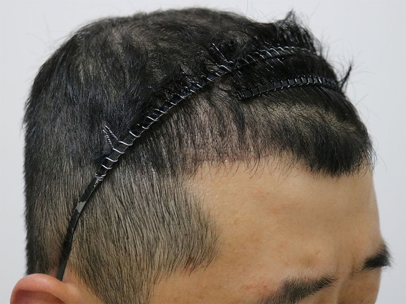 수술 후 2.jpg