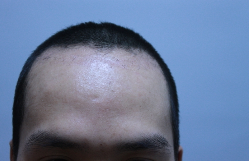 One month of forehair transplantation