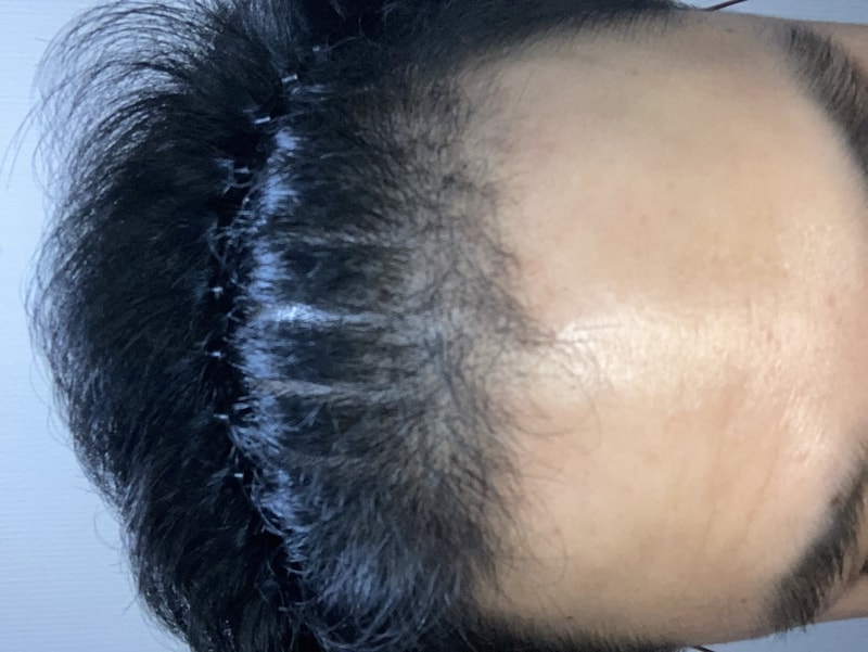 모발이식 140일 경과 +고화질 사진 추가