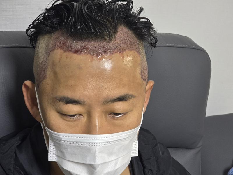 手術当日から2週間目の写真です