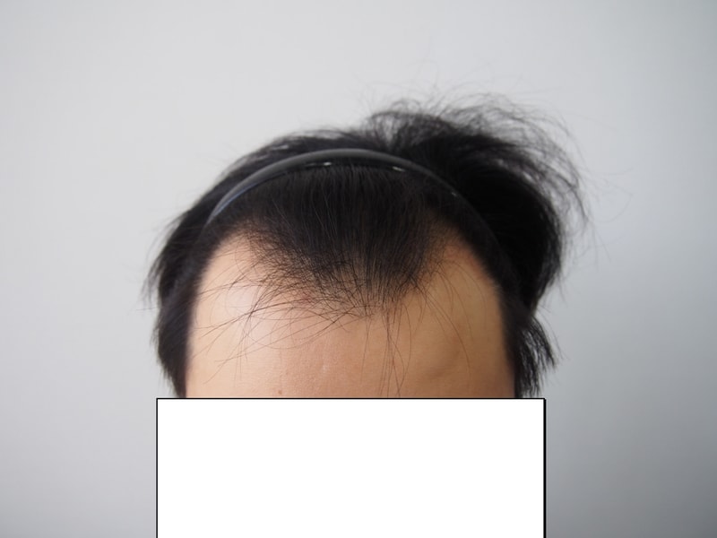 수술후 1년경과 후기입니다.