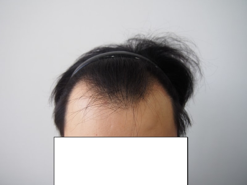 수술후 8개월경과 후기입니다.