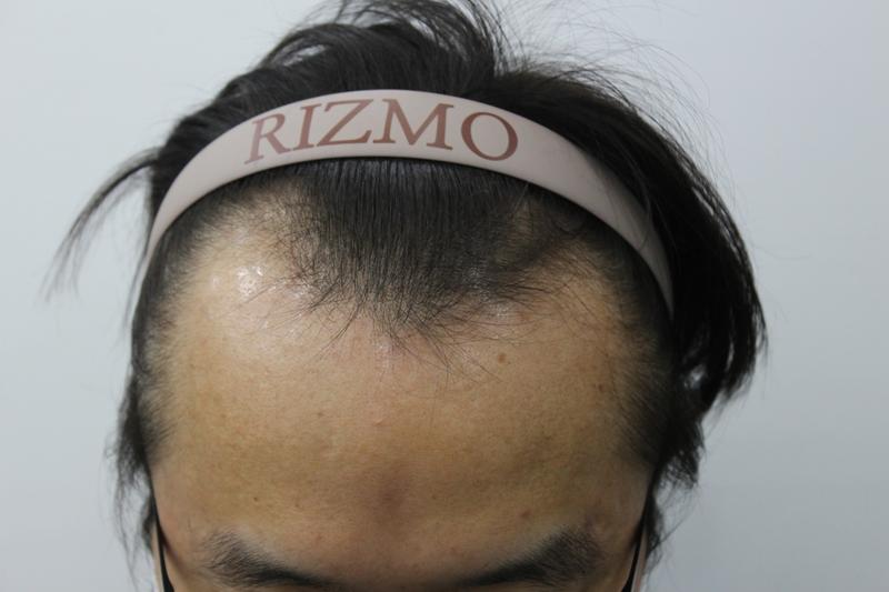 Lizmo, 8 months old, 3,000 caps, M-shape correction