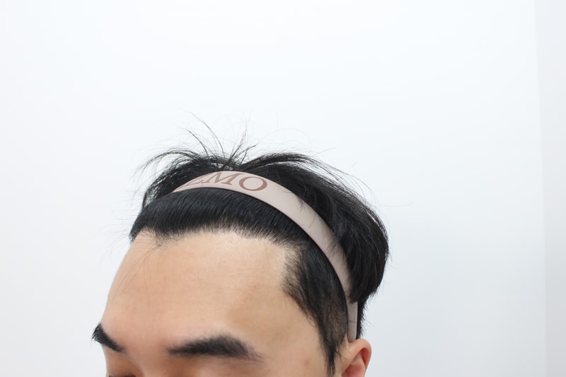 수술후8개월차 옆.jpg