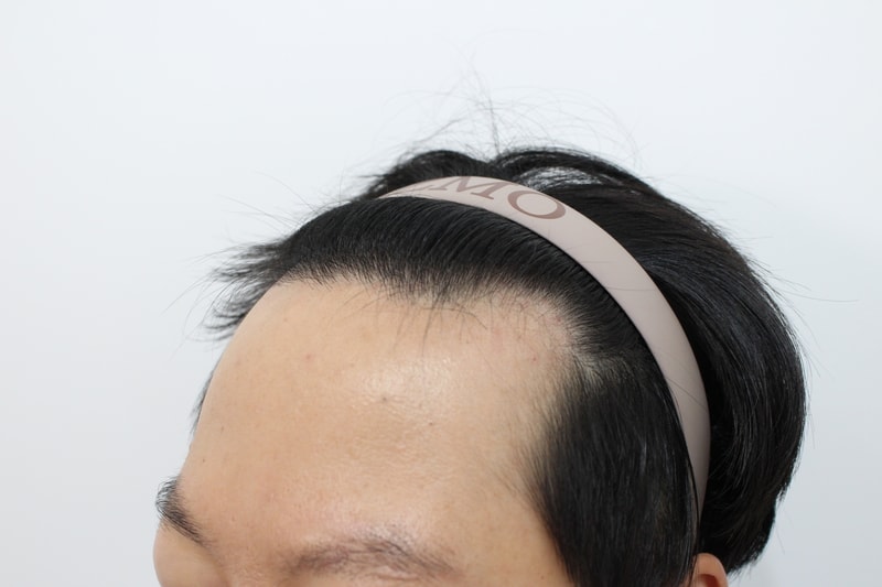 7수술전 오른족.jpg