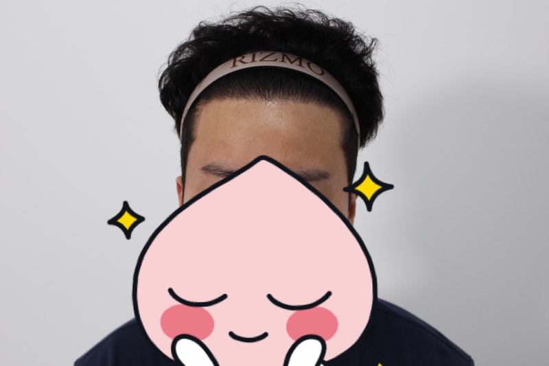 수술후 1년차 풀샷.jpg