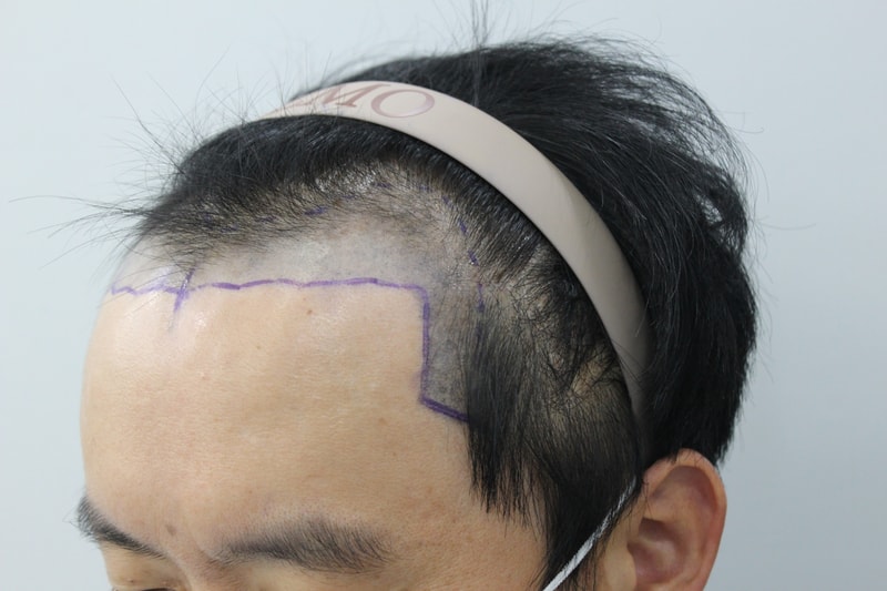 수술전옆.jpg