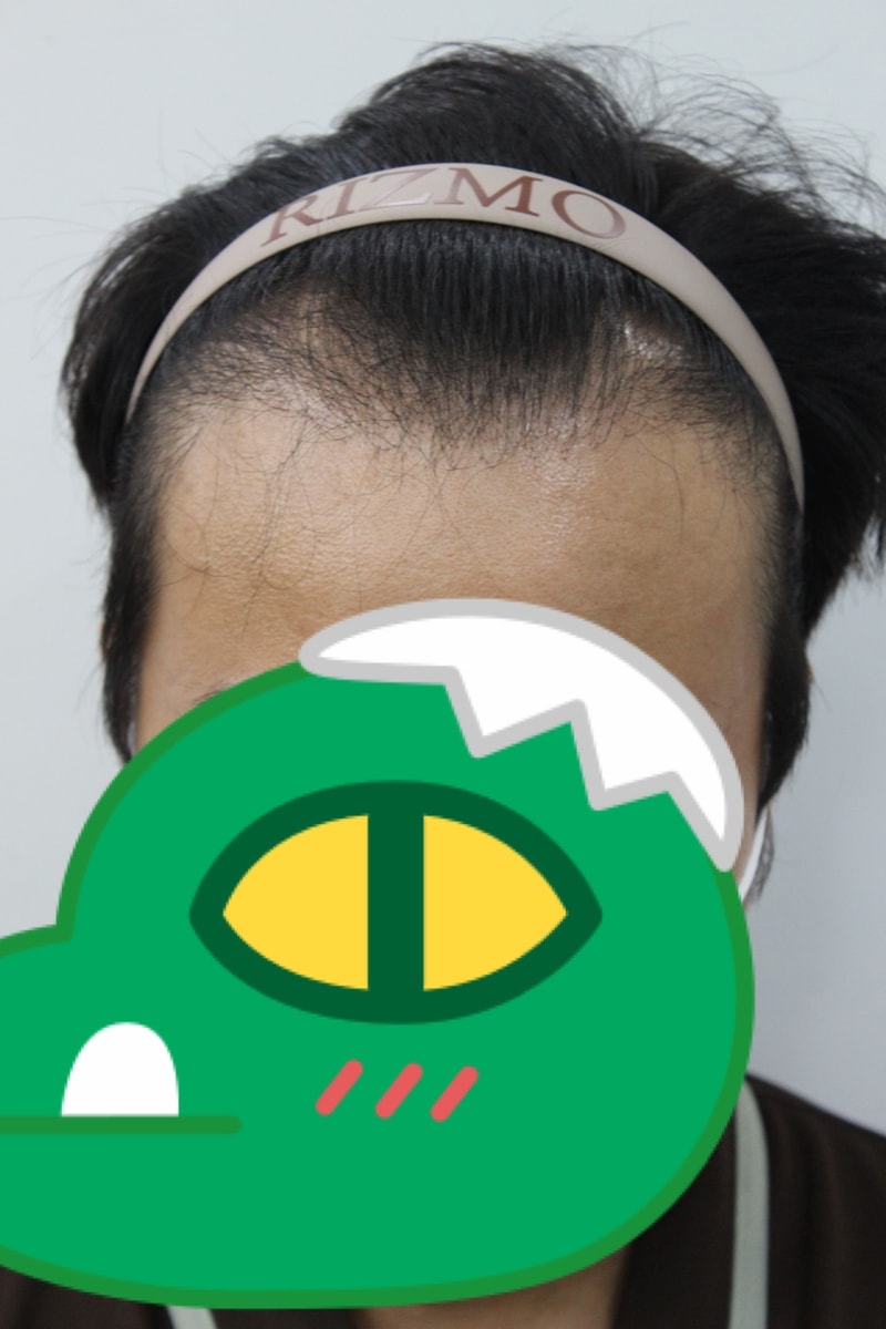 수술전 앞모습 풀샷.jpg