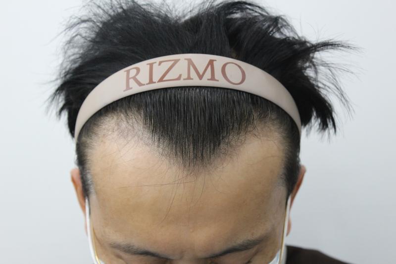 2500本の毛無削髪手術から1年が経過します。