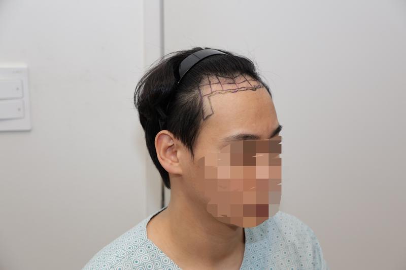 New Hair Seoul Branch/Cutting/ 2000 hair follicles (4,000 hair)/ Late 3 months