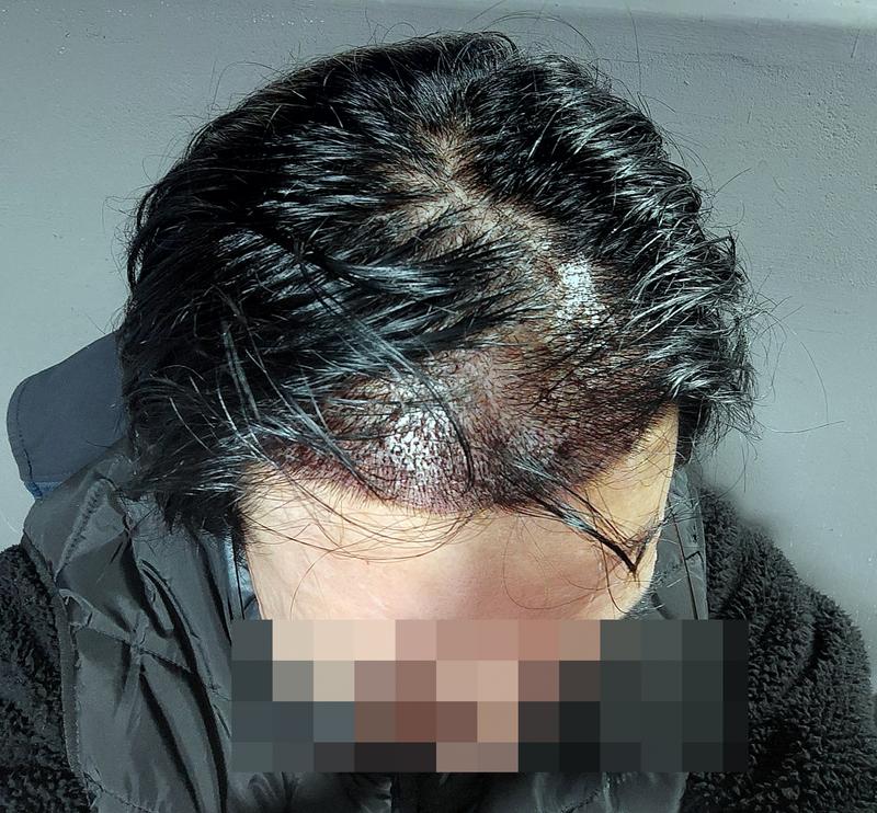 This is the third day of hair transplantation.