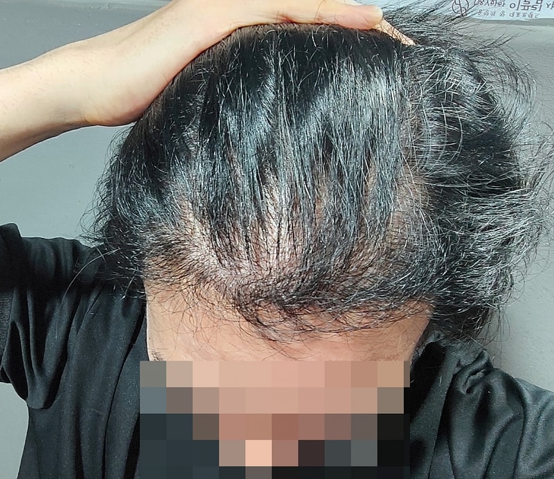 非切開 毛髪移植 3千本 6ヶ月経過 写真