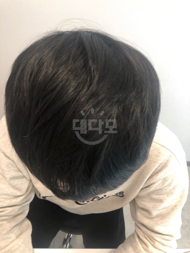 수술후6개월1.jpg