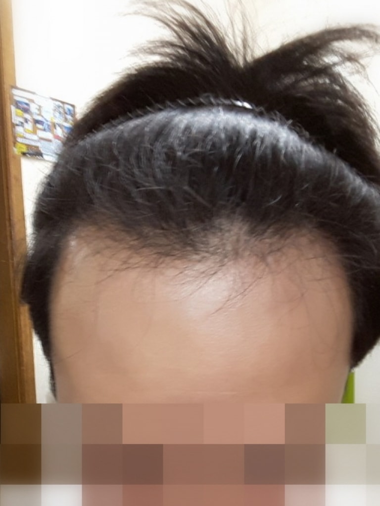 Finally, I got a non-cut, no-cut, 3,500-mo transplant