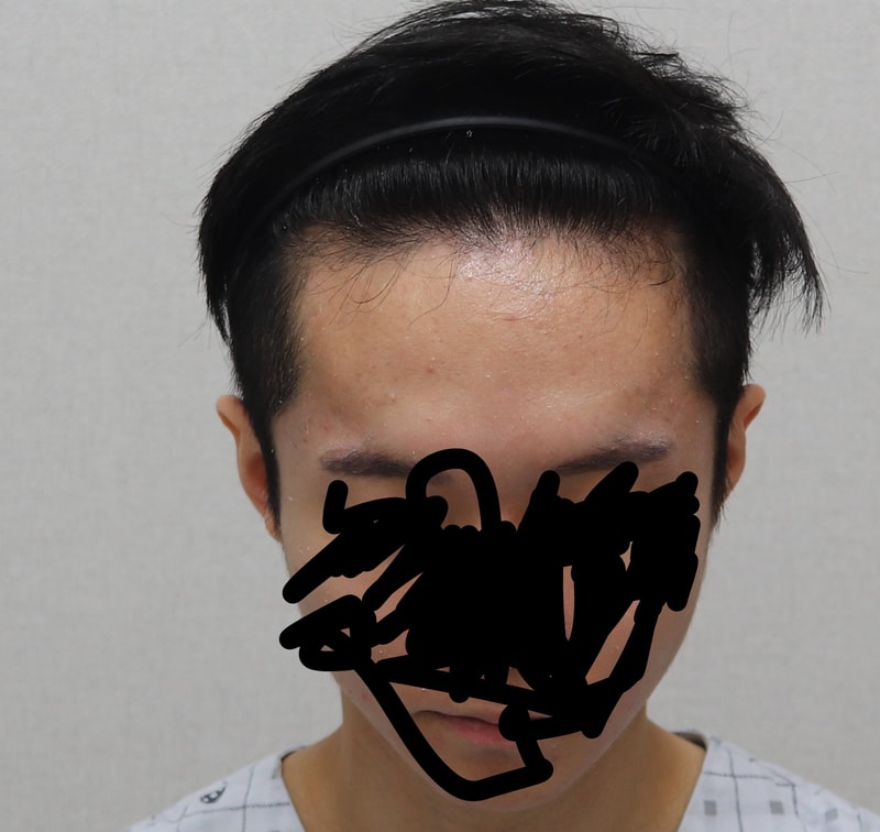 수술 전 정면.jpg