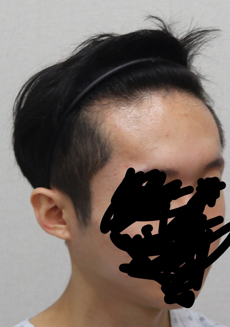 수술 전 옆면.jpg