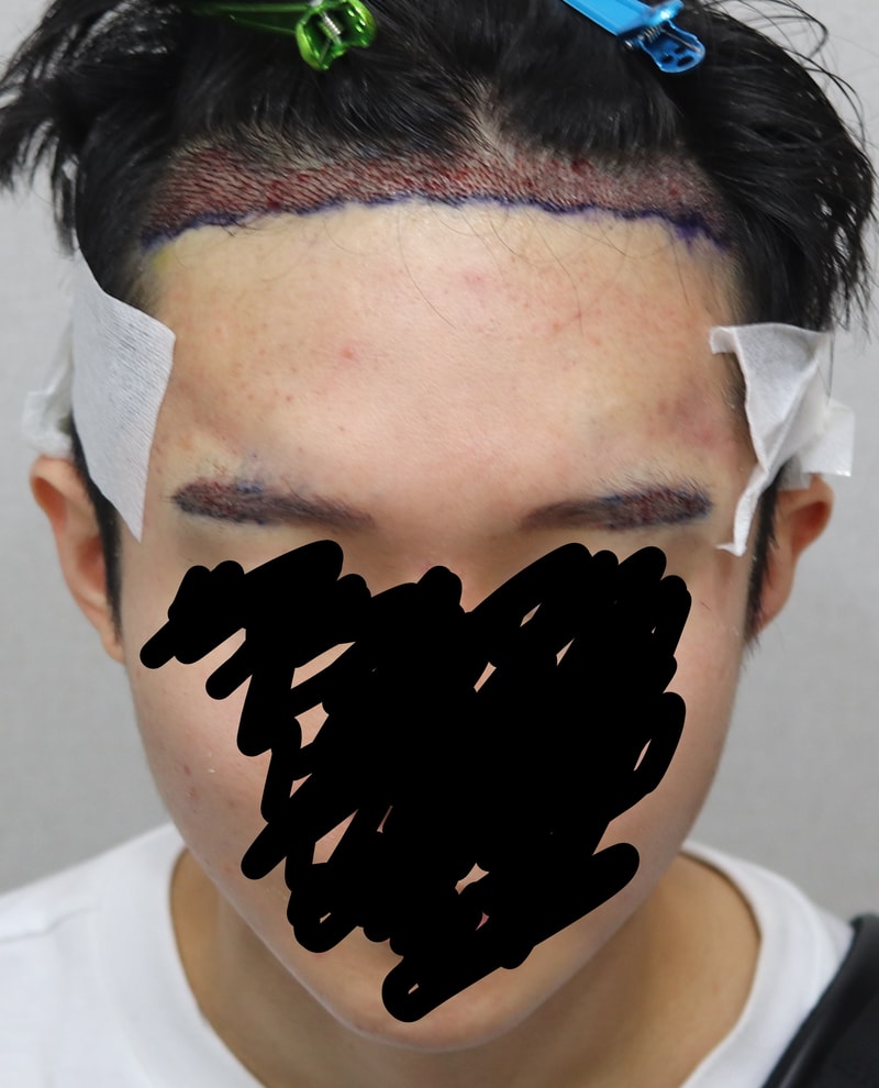 수술 후 정면.jpg