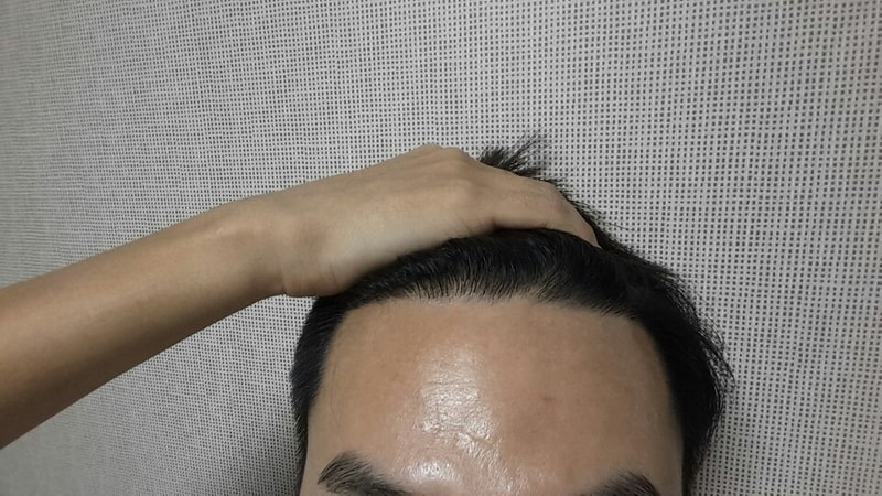 이제  2000모낭 1년차입니다.