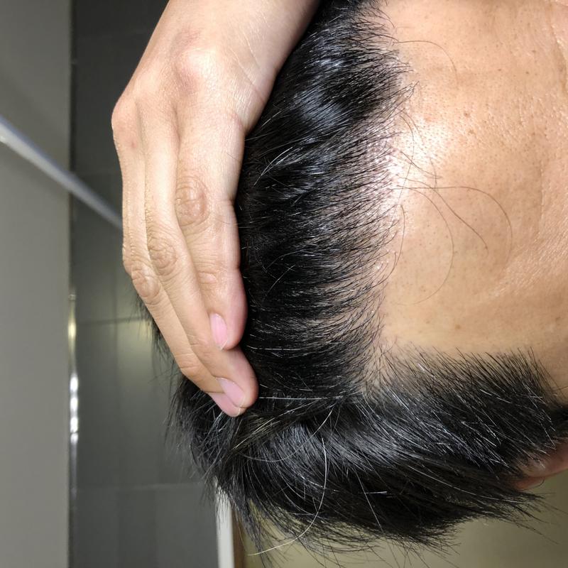 절개식 모발이식 6개월 경과