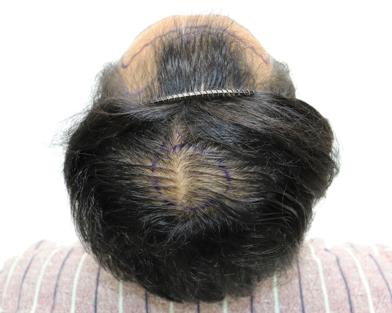 Thank you for your Christmas gift at the 4 Hair Daegu store! I filled in the top of my head + M