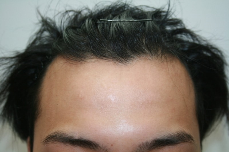 ポヘア毛髪移植8ヶ月目のレビューです。