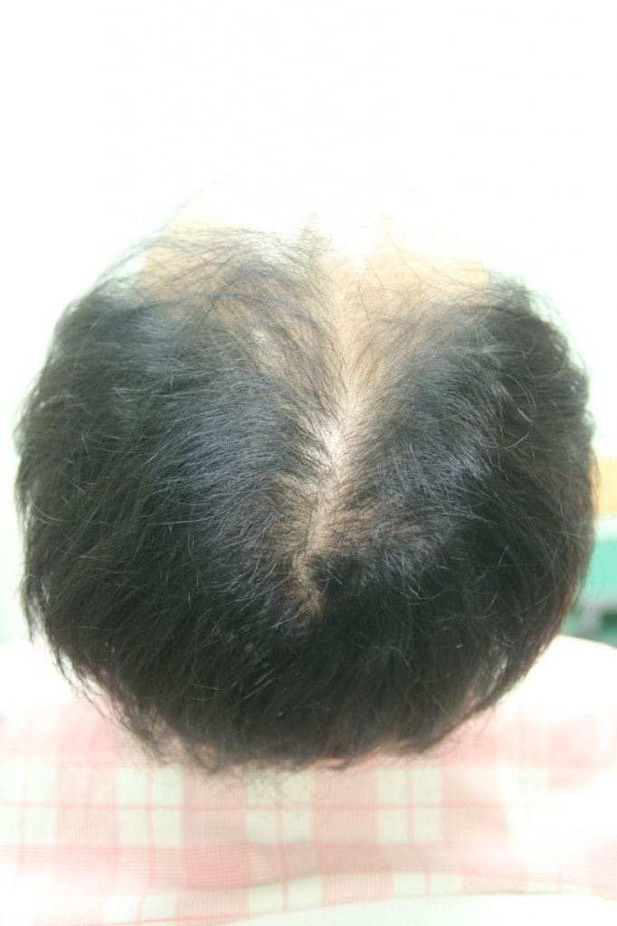 Boxcut + Situage 2000 hair follicle surgery.
