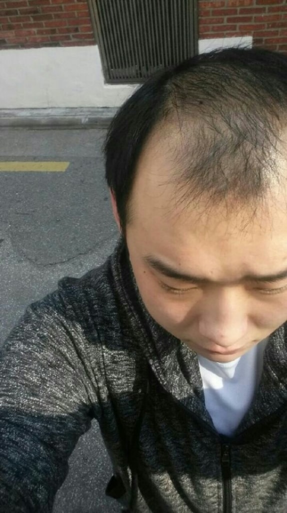 It's been about seven months since my surgery.. After I touch my hair