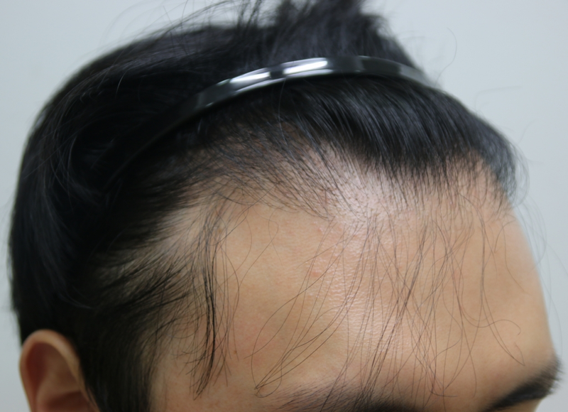 FOHAIR毛发移植中心 盒子式剪裁 非切开 1200毛囊