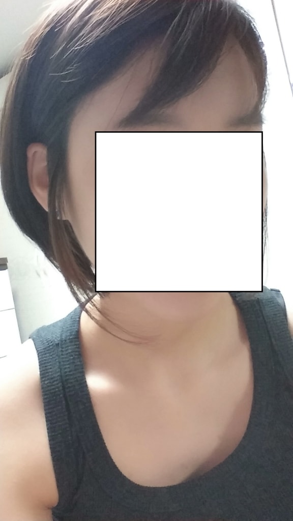 ダナ整形外科 ヘアライン手術1ヶ月レビュー！@!@!@！