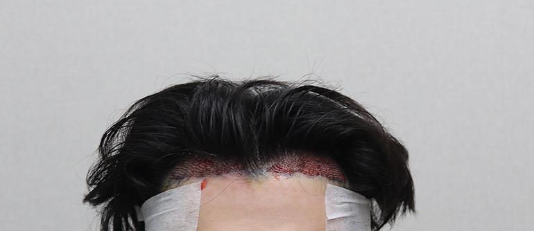 모플러스 비절개 2000모 4개월차 후기