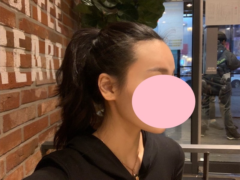 [4 months] I should've done my hairline earlier