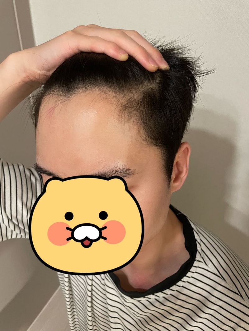 대구 포헤어 비절개무삭발 M자탈모 슬릿모발이식 당일~3일차 후기