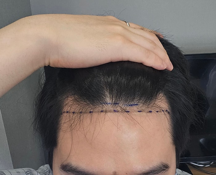 4-디자인그리고 잠깐 회복실에서 대기할때 찍음.jpg