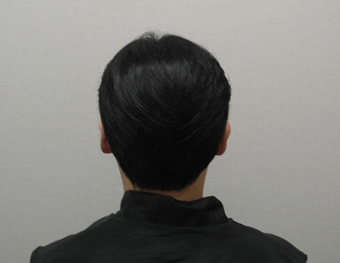 9- 수술다음날 뒷머리 사진입니다 무삭발로 수술해서 티가 1도 안나서 좋았어요 비용은 비쌌지만요 ㅠ 다음날 오후에 출근해야해서 어쩔 수 없이 무삭발로 진행.JPG