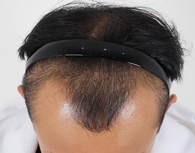 Daegu Momo Immediately after surgery, mixed 5,500 moles